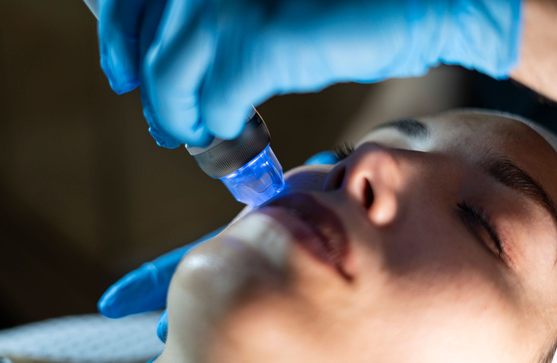 Tratamientos: ALATO MICRONEEDLING RF/ DERMAPEN