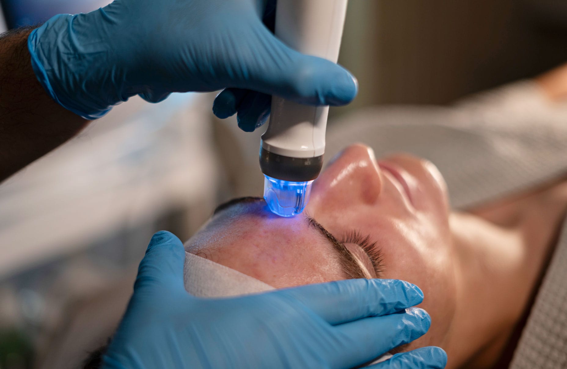 Tratamientos: ALATO MICRONEEDLING RF/ DERMAPEN-2