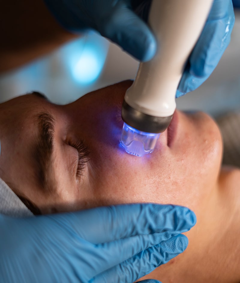 Tratamientos: ALATO MICRONEEDLING RF/ DERMAPEN-4