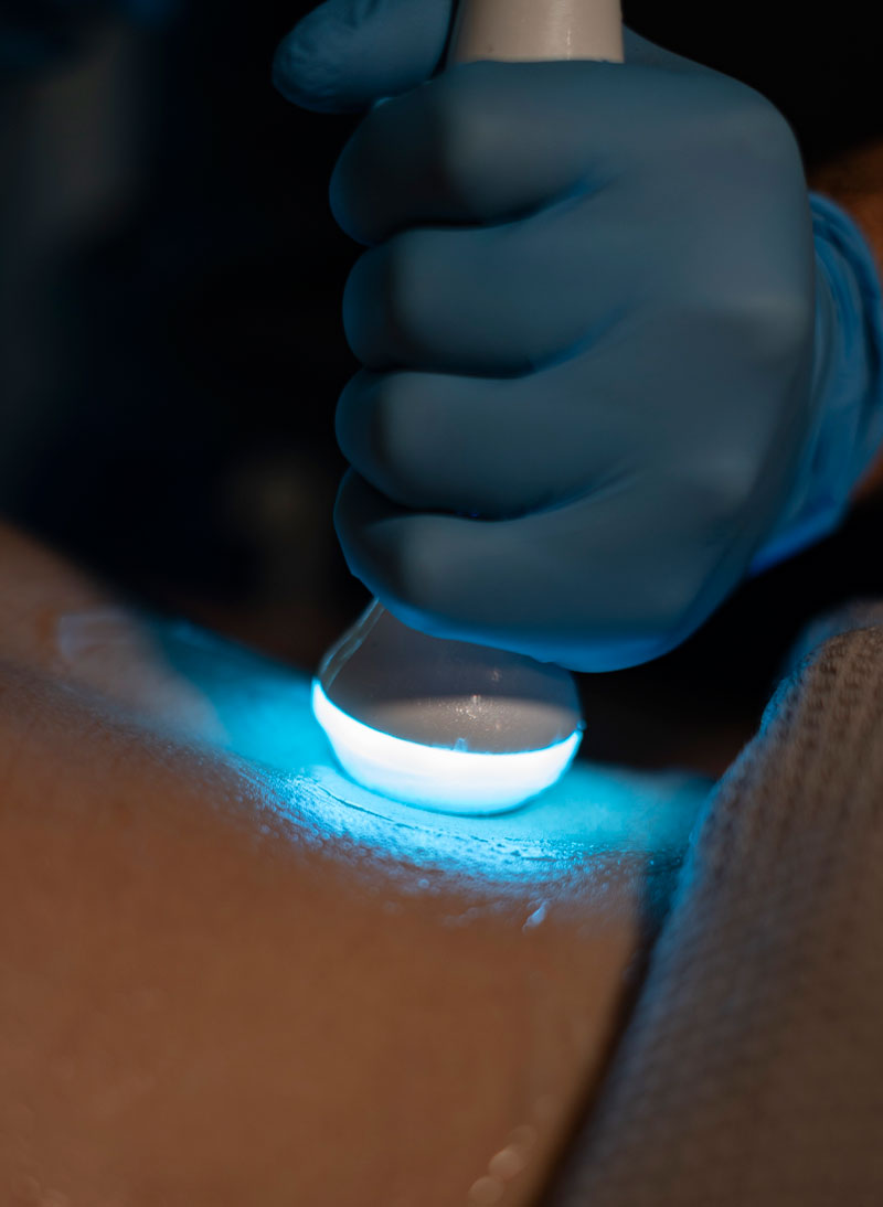 Tratamientos Alato: BACNE TREATMENT